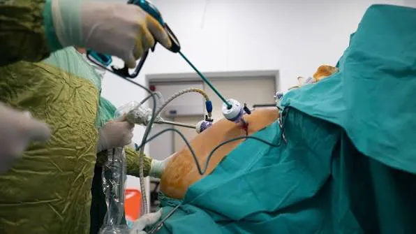 Bariatric Surgery