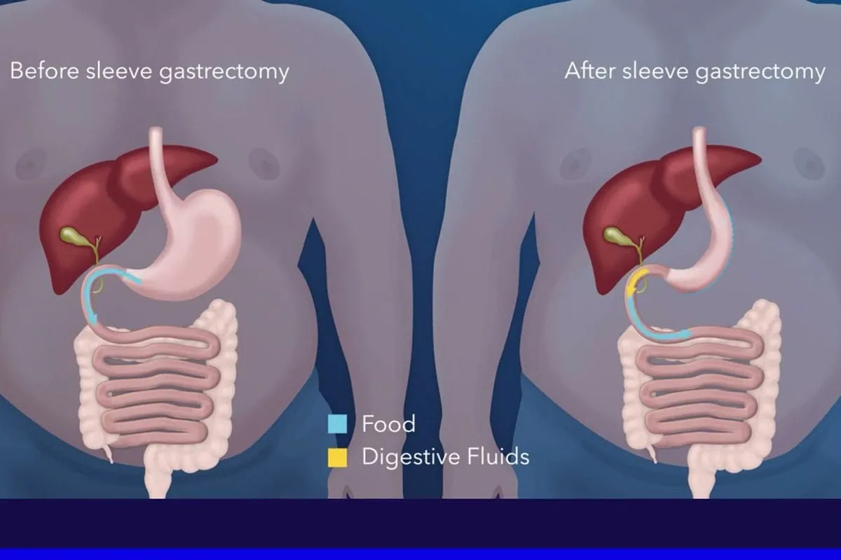 Gastric sleeve surgery in Tijuana Mexico